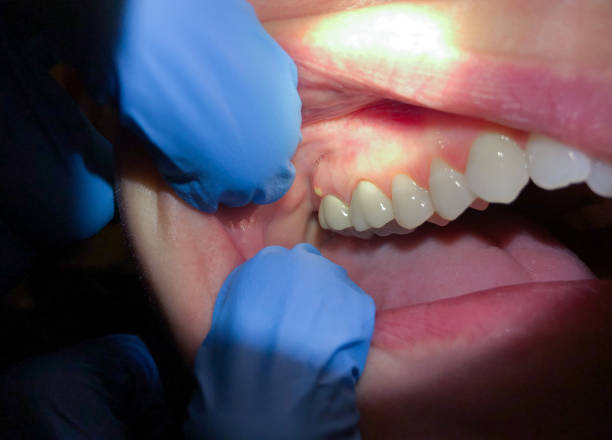 Best Emergency Wisdom Teeth Removal in Mattituck, NY